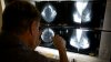 Study Finds That More Breast Cancer Patients Can Forgo Mastectomies and Choose Smaller Surgery