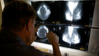 Mammograms should start at 40 to address rising breast cancer rates at younger ages, new guidelines says