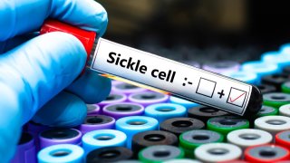 Blood sample of patient positive
 tested for sickle cell.