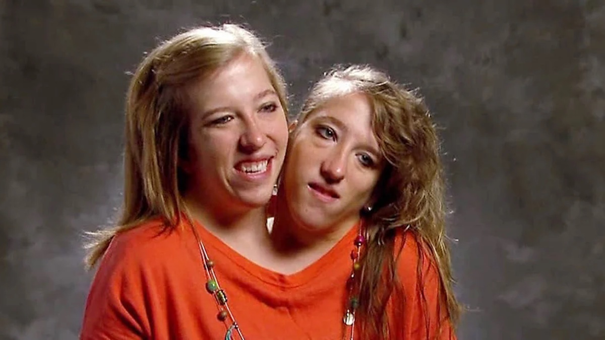 Conjoined Twin Abby Hensel Is Married NBC10 Philadelphia   Abby And Brittany Hensel 