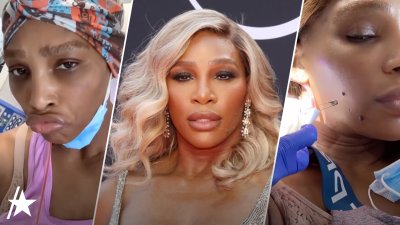 Serena Williams had grapefruit-sized cyst removed from neck